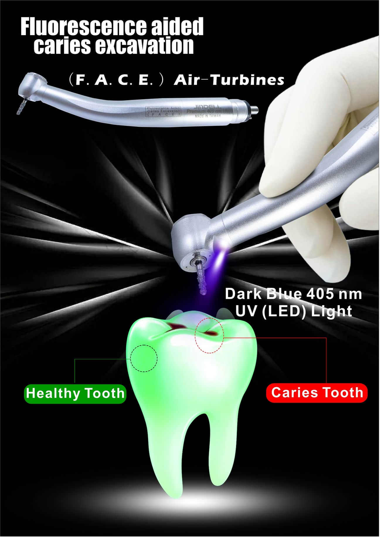 Fluorescence aided caries excavation (FACE) Turbines
